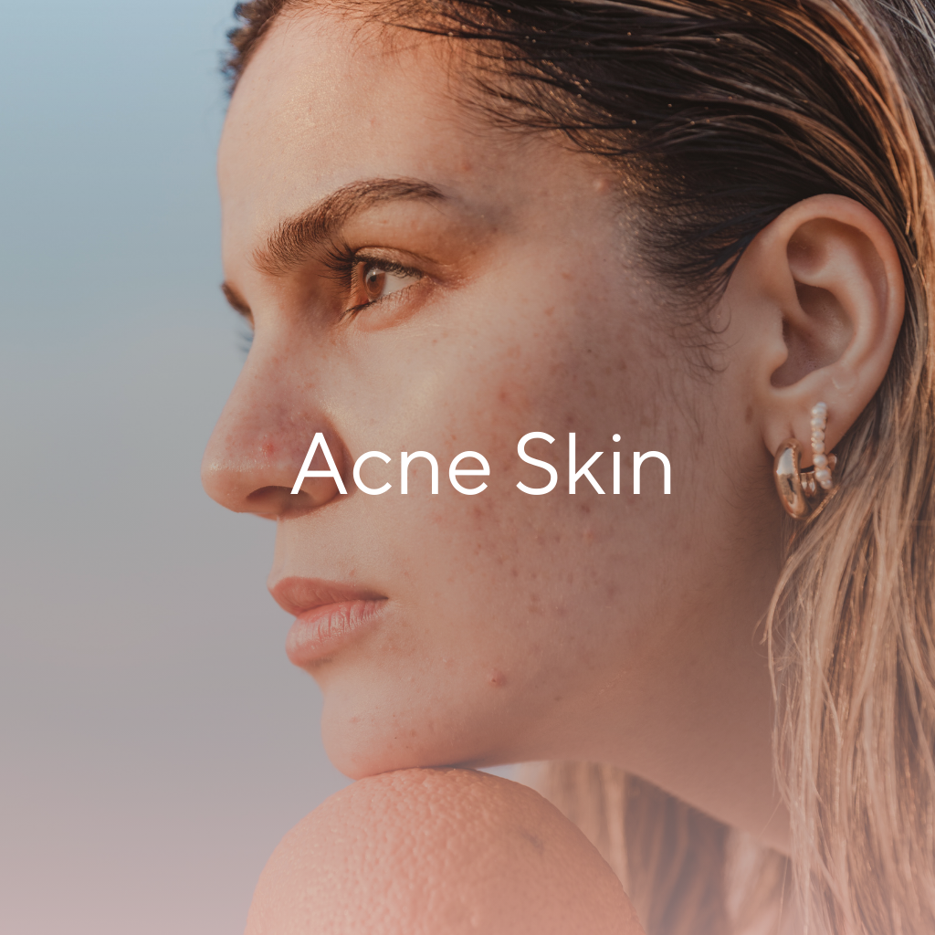 Acne Skin